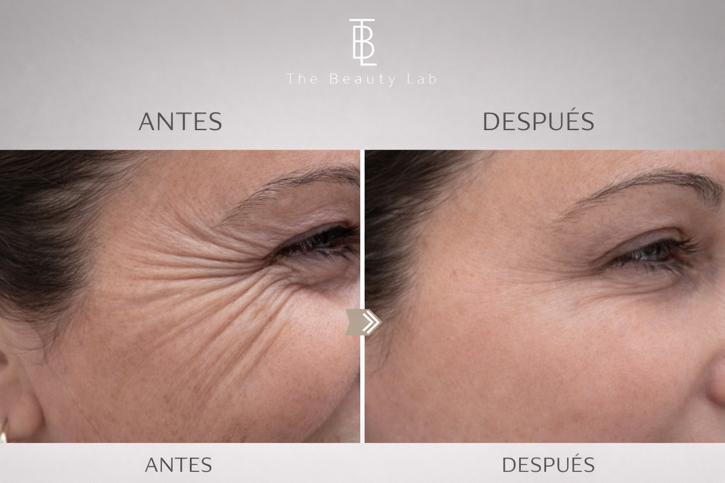 Toxina Boutulínica Arrugas de Expresión