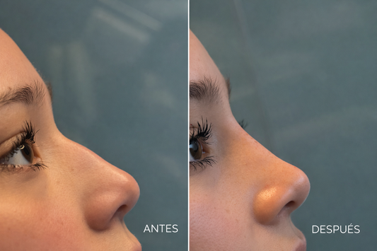 Rinomodelación Sin Cirugía