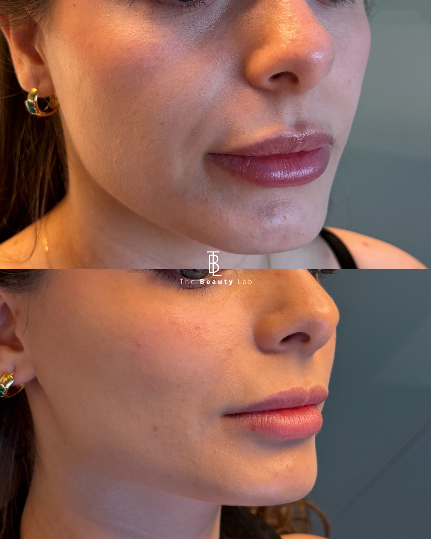 Aumento y definición de pómulos