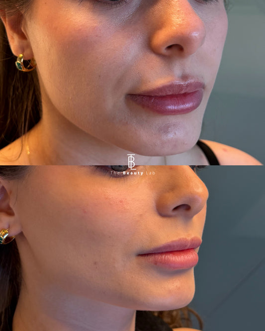 Aumento y definición de pómulos