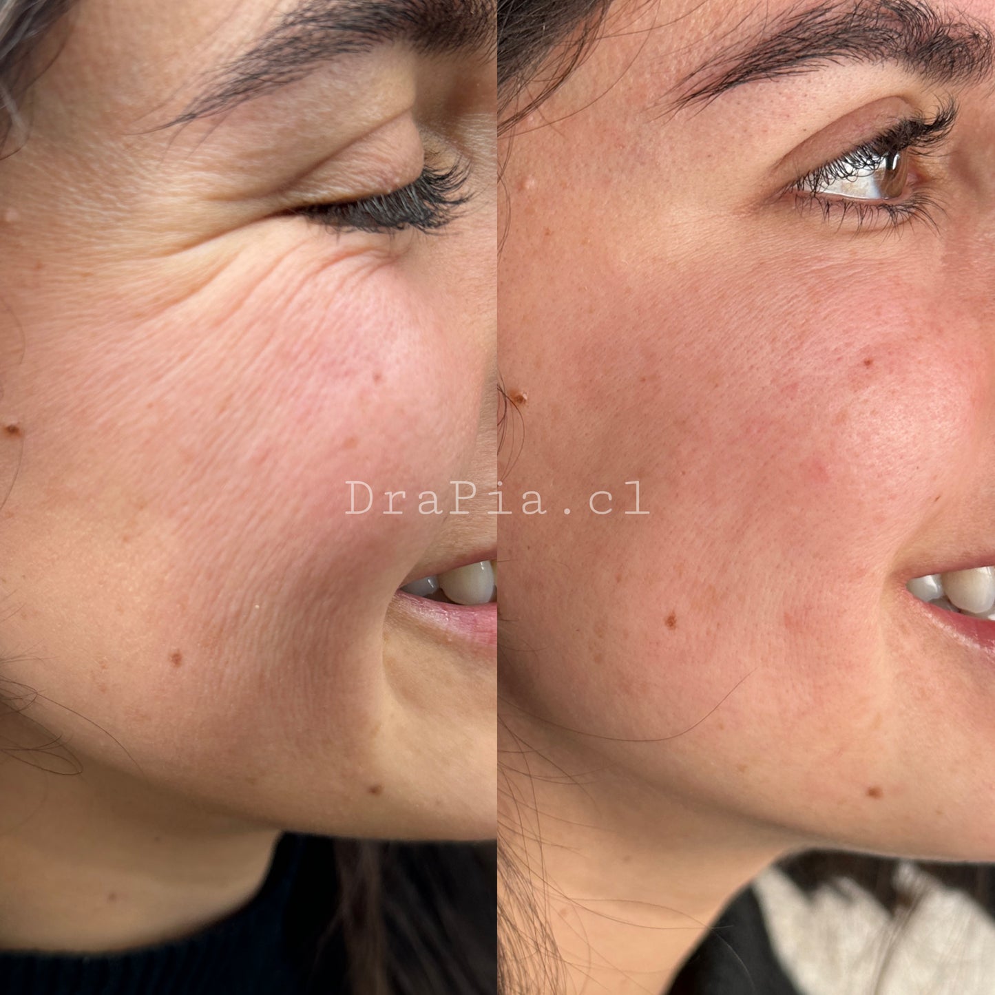 Skin Booster