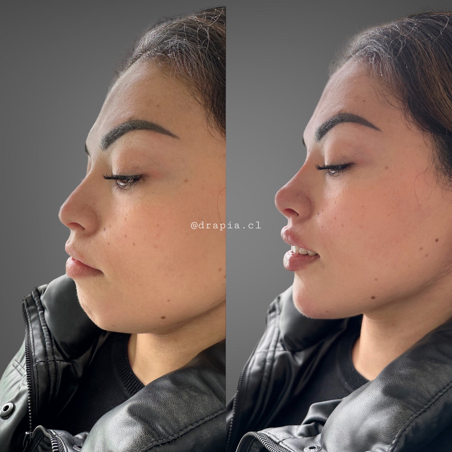 Perfiloplastia – Armonización del perfil facial