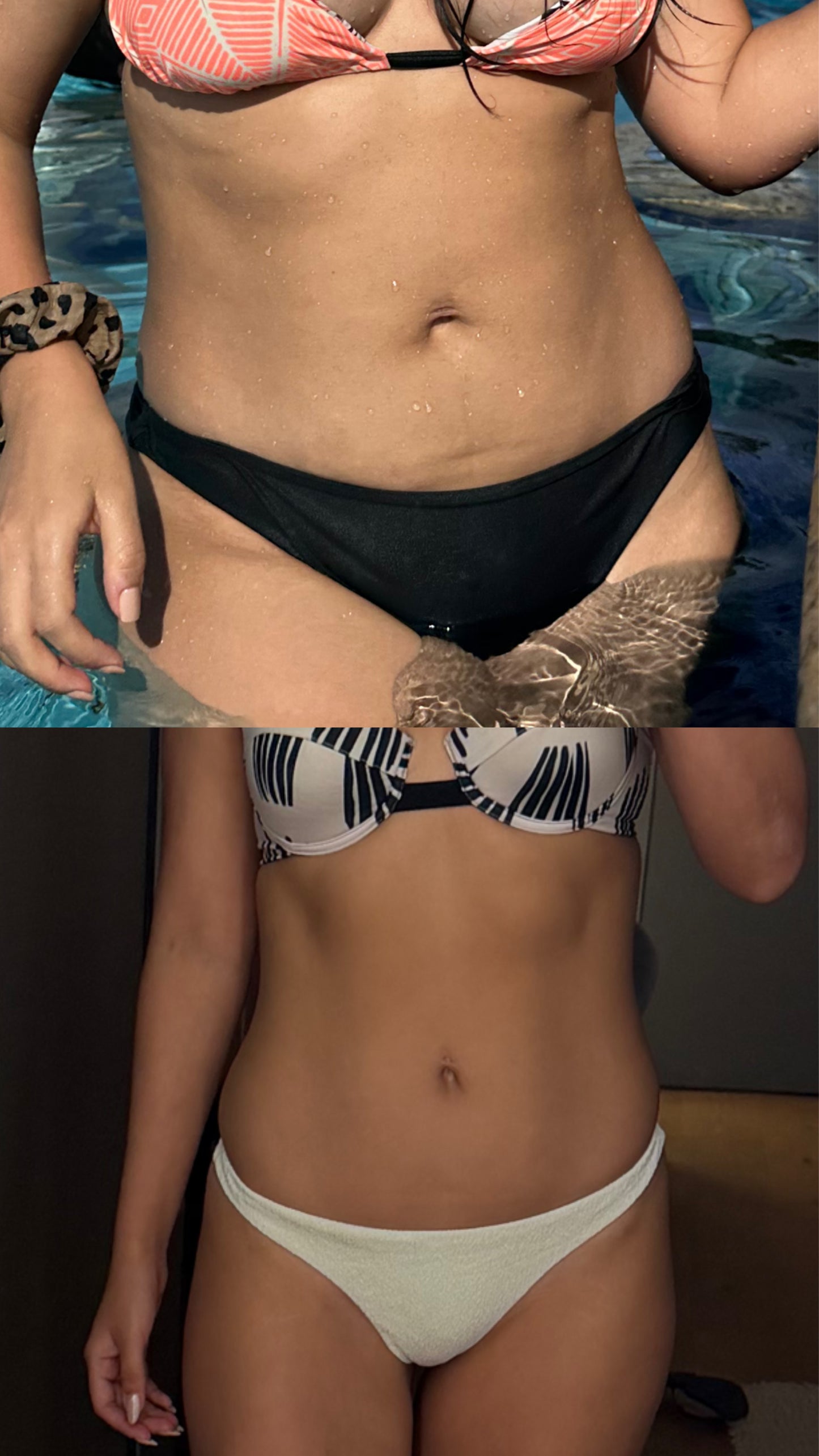 Post parto - Abdomen