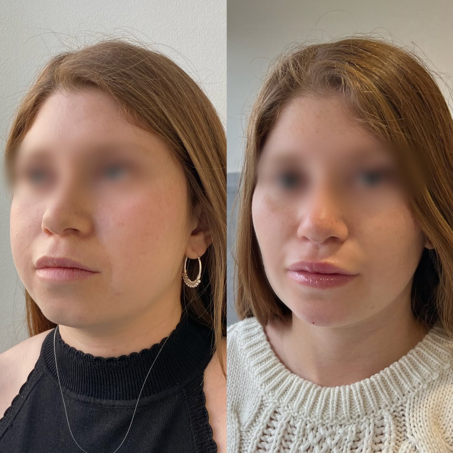 Bichectomía – Afinamiento del contorno facial