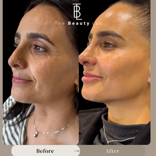 Rejuvenecimiento facial