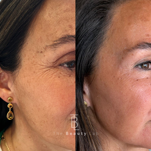 Resurfacing con Láser CO2 Tetra Pro