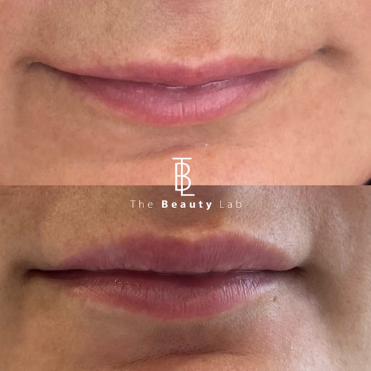 Lip Flip – Definición natural del labio superior con Toxina Botulínica