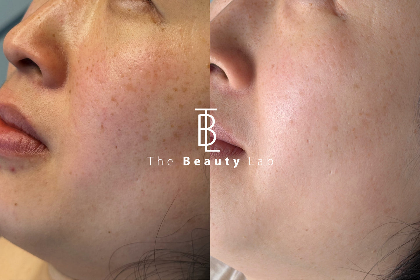 Plataforma Stellar M22/ IPL + NDYAG