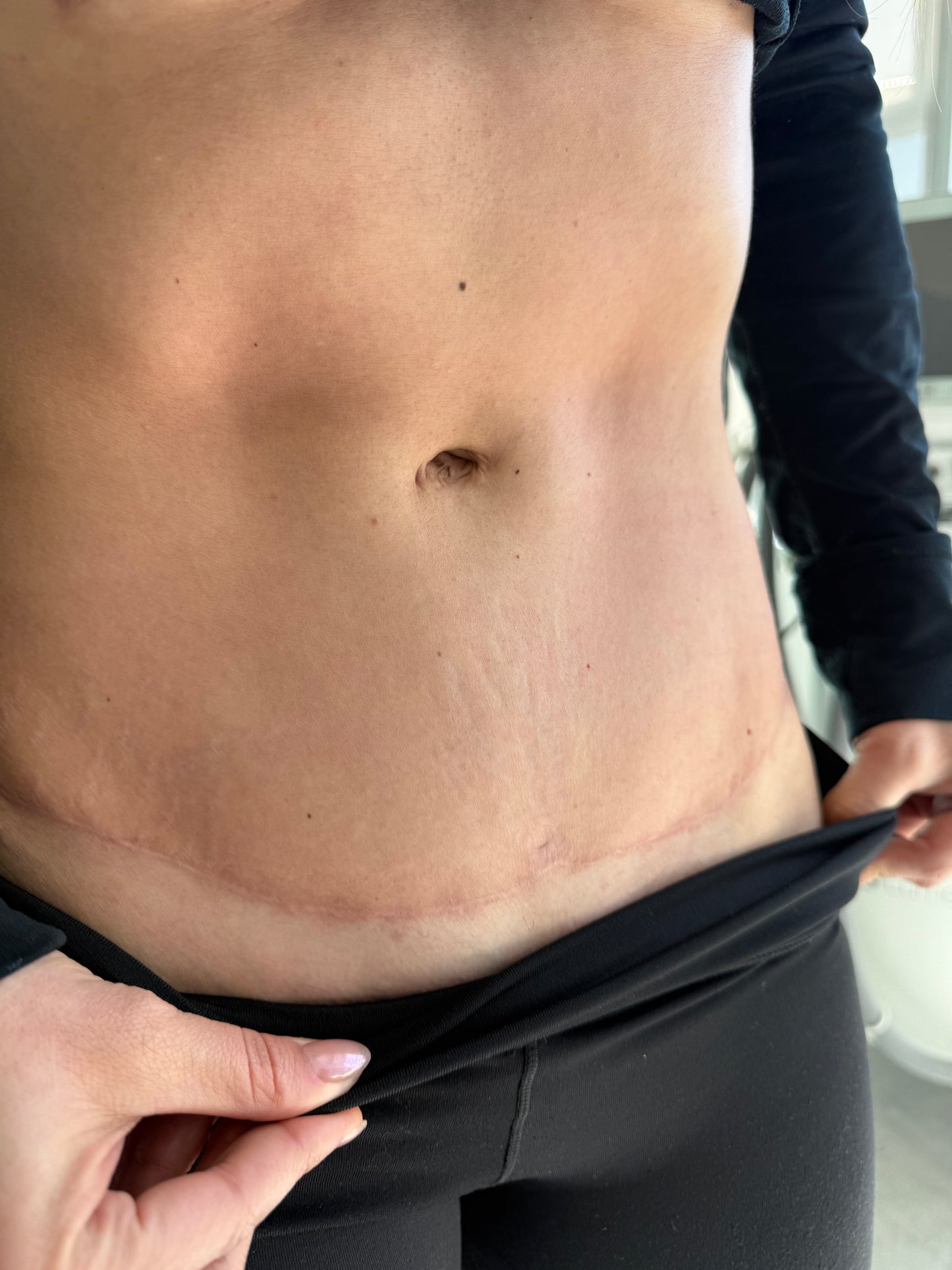 Tratamiento de estrias con laser Co2