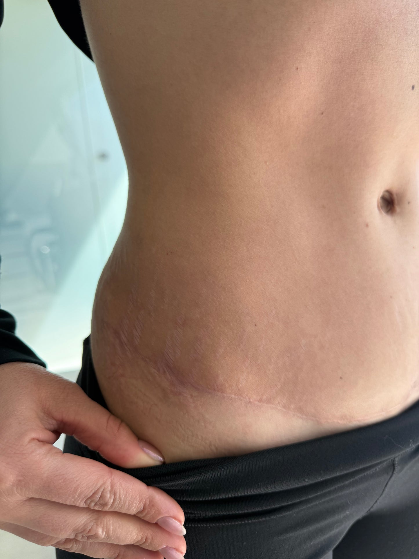 Tratamiento de estrias con laser Co2